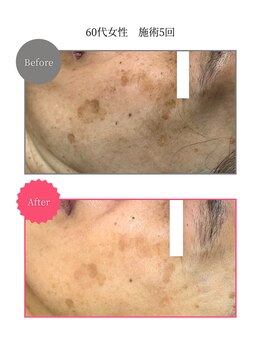 ボータン 恵(Beau Temps)/ウルトラ光トーニング/シミ改善