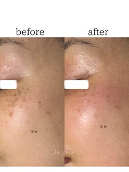 ラペ(la paix)/フェイシャル症例写真