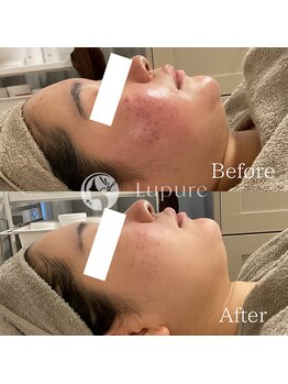 ルプレ(Lupure)/ハーブピーリング9回目