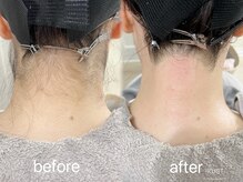 うなじワックス結婚式や成人式前に