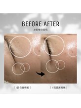 マカナ(Makana)/ララピール*シワ改善BeforeAfter