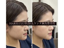 ハリルル 併設 GLケンタ鍼灸整骨院(HARILULU)/美容鍼でたるみ改善