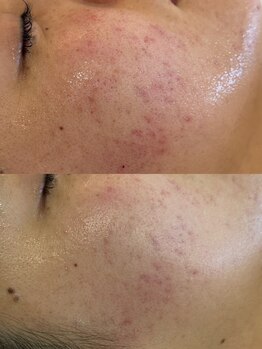 ベル(Belle)/Eポレーションで美容液導入★