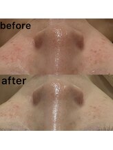 アミュレット(amulette)/毛穴ケア