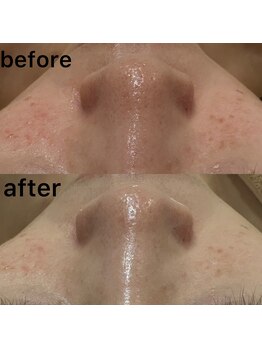 アミュレット(amulette)/毛穴ケア