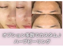 オアナヨーク(oana yoak)/国産ハーブピーリング♪