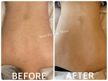 ハーブピーリング 恵比寿/背中ニキビ/くすみ改善