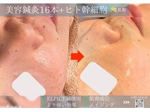 ミエリア美容鍼灸院(mielia美容鍼灸院)/幹細胞美容鍼灸〈幹細胞facia〉