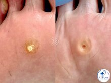 プラスワンフット 本厚木(+1 Foot)/タコ・魚の目ケア！痛みから解放