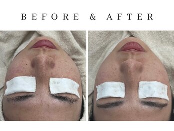 ルシェリア(Le cherien)/小顔リフトアップ