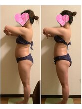 カレン/深層筋膜リリース