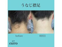 アクト クロ(ACT curro)/【うなじ襟足】脱毛施術例