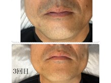 ラヴィエール(Laviere)/【メンズ脱毛】お髭