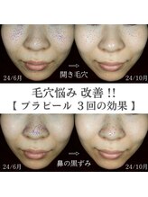 イロハ(IROHA)/プラピール×LDM×プラズマ