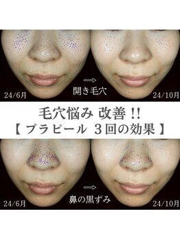 イロハ(IROHA)/プラピール×LDM×プラズマ