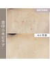 【背中ハーブピーリング各種】１ヶ月以内の再来店の方限定★《10％OFF》