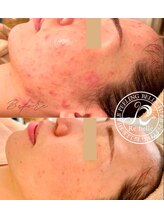 クリア 麻布十番(CLEAR)/リベルハーブピーリング　ツヤ肌