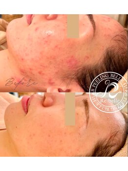 クリア 麻布十番(CLEAR)/リベルハーブピーリング　ツヤ肌