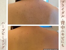 ラナ(LaNa)/ブライダルに背中のケア◎