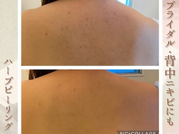 ラナ(LaNa)/ブライダルに背中のケア◎