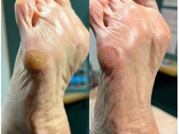 足のトラブルセンター 狸小路店/角質除去