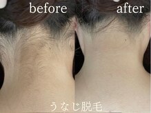 ミノア 大野城店(MINOA)の雰囲気（うなじをデザインする時代　うなじ脱毛）