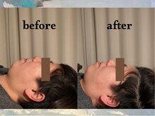 寝譜(nefu)/美容鍼BeforeAfter