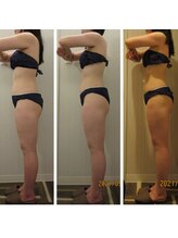 パルティール(PARTIR)/◆痩身　症例写真