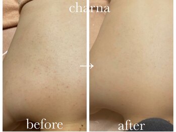 シャルナ(charna)/ハーブピーリング症例