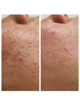 トータルビューティーサロン ナーズ(NAZ)/ハイドロピーリング毛穴洗浄