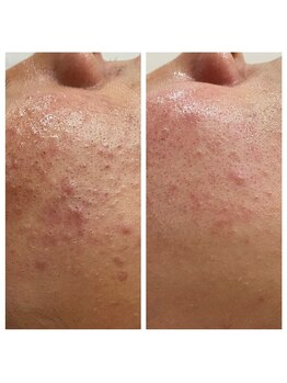 トータルビューティーサロン ナーズ(NAZ)/ハイドロピーリング毛穴洗浄