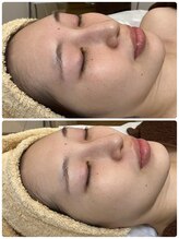 ジェニー(JENNI)/トロイアルケ　スキンケアのみ