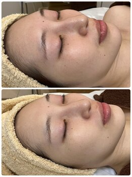 ジェニー(JENNI)/トロイアルケ　スキンケアのみ