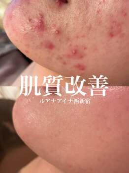 ルアナアイナ(Luana Aina)/ハーブピーリングでニキビケア