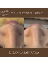 リリアーナ アサヒカワ(LILIANA ASAHIKAWA)/ハイドラ毛穴洗浄＋顔脱毛