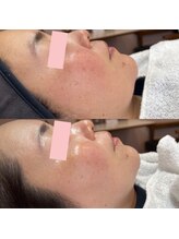 ラティーク 諫早西口店/マリムーブフェイシャルWAX