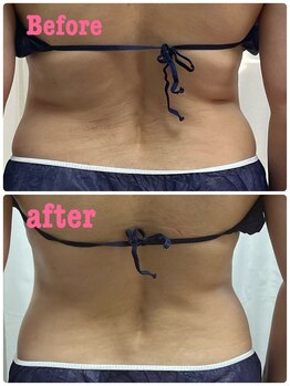 アスピリア(aspirer a')/背中のハミ肉スッキリ.！