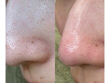 サイ(Sai)/至近距離では恥ずかしい