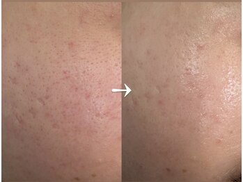 クレア(Claire)/アンストレス1回