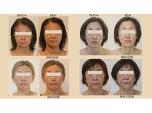 ビューティーセラピーマジック 自由が丘店(Beauty Therapy Magic)/顔だけじゃない！根本たるみケア