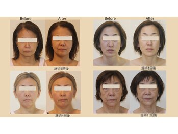 ビューティーセラピーマジック 自由が丘店(Beauty Therapy Magic)/顔だけじゃない！根本たるみケア