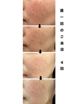 スパチャーレ(Spa ciare)/ヒト幹細胞培養上清液使用