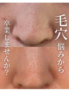 ココリール/毛穴の悩みから卒業しませんか？