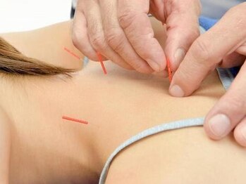 鍼灸ハリカラの写真/【国家資格者が対応◎】ガチガチの首・肩こりを“本格鍼灸×整体”で根本改善！