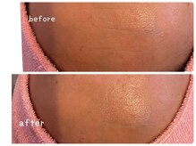 ヒメミ(Himemi)/ＢＢＬ光フェイシャル