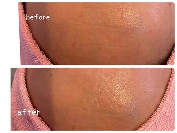 ヒメミ(Himemi)/BBL光フェイシャル