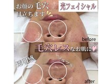 サロン(SALON)/光フェイシャル