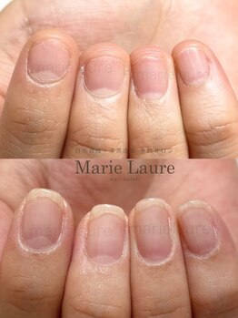 マリーロール 梅田店(Marie Laure)/深爪矯正/自爪育成/自爪風