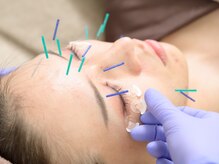 ドットニホカ(.NIHOKA)の雰囲気（微細な鍼による、美容鍼『.NIHOKA美鍼』）