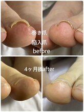 フロー(Froh)/巻き爪　陥入爪